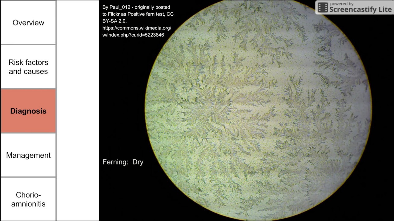 Premature rupture of membranes